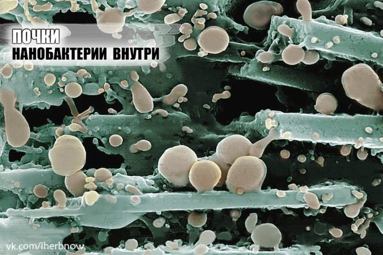 Подробнее о статье Наличие нанобактерии в организме вызывает отложения кальция