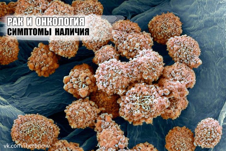 Подробнее о статье Признаки онкологии в организме и почему возникают